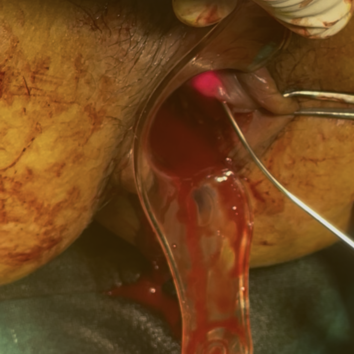 laser surgery for piles